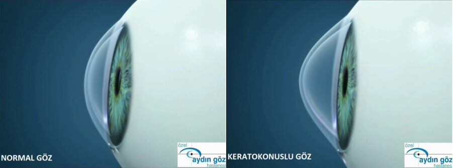 Kuru göz sendromu Kuru göz sendromu
