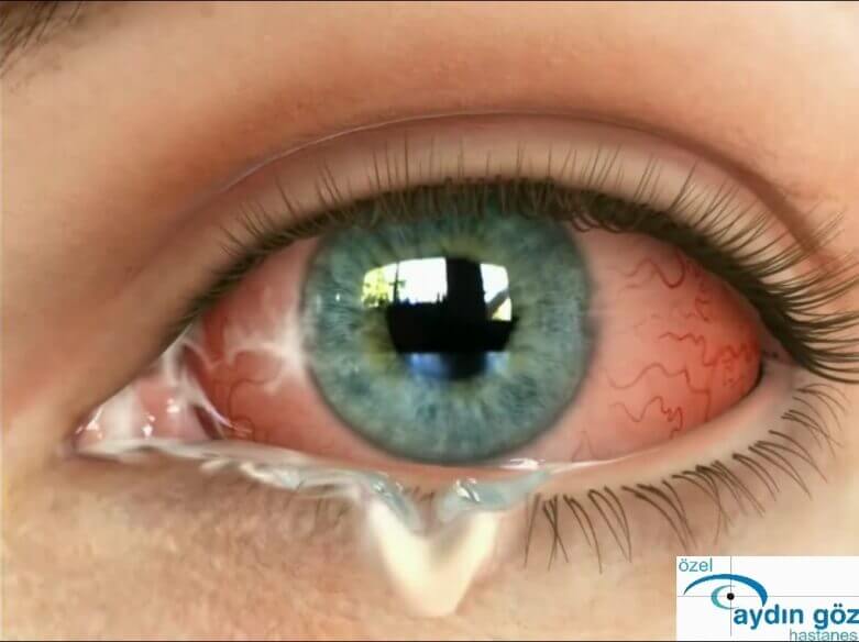 Kontakt Lens Aydin Soke Goz Hastanesi
